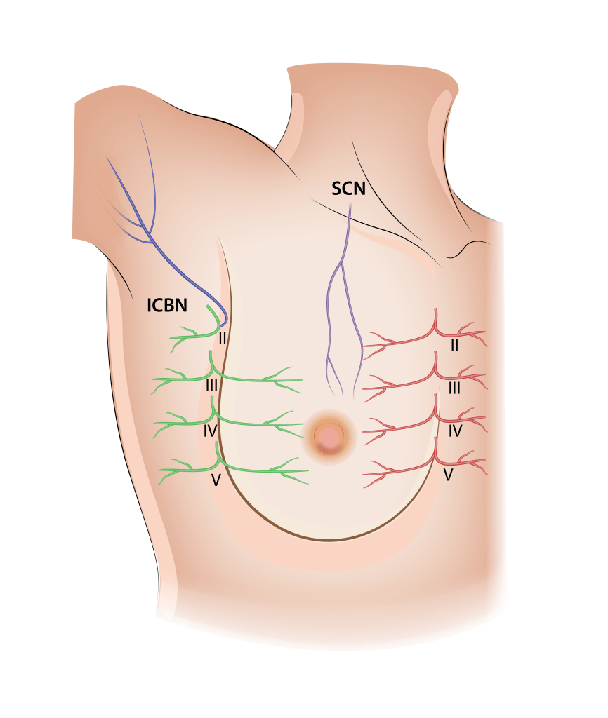 Intercostal nerves (green and red) – injury can cause pain in the back, the side of the chest, and the front of the chest and breast. Intercostobrachial nerve (blue, ICBN) – can cause pain in the inside of the upper arm. Supraclavicular nerve (purple, SCN) – can cause pain in the upper chest and breast. 