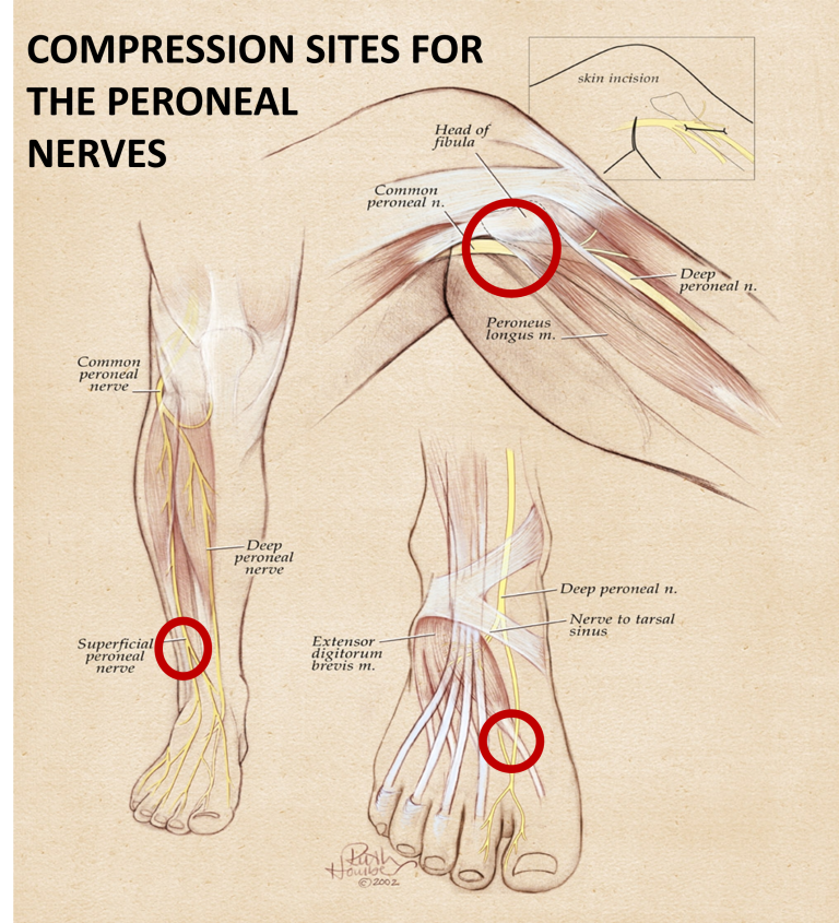 Foot Pain Foot Drop Neuropax Clinic Is The St Louis Leader For