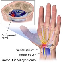 Neuropax Clinic is the St. Louis Leader for Carpal Tunnel, Headache Surgery, Nerve Compression, thoracic outlet syndrome and Chronic Joint Pain.