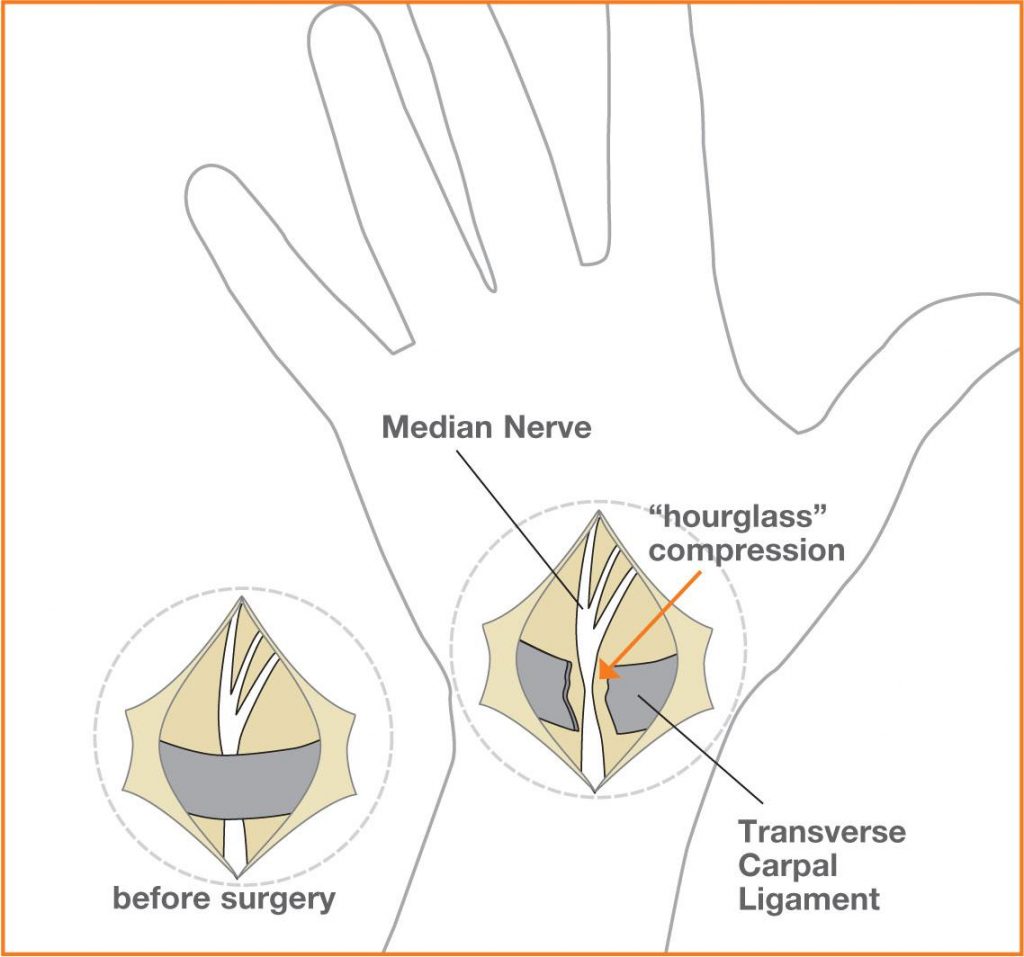 Neuropax Clinic is the St. Louis Leader for Carpal Tunnel, Headache Surgery, Nerve Compression, thoracic outlet syndrome and Chronic Joint Pain.