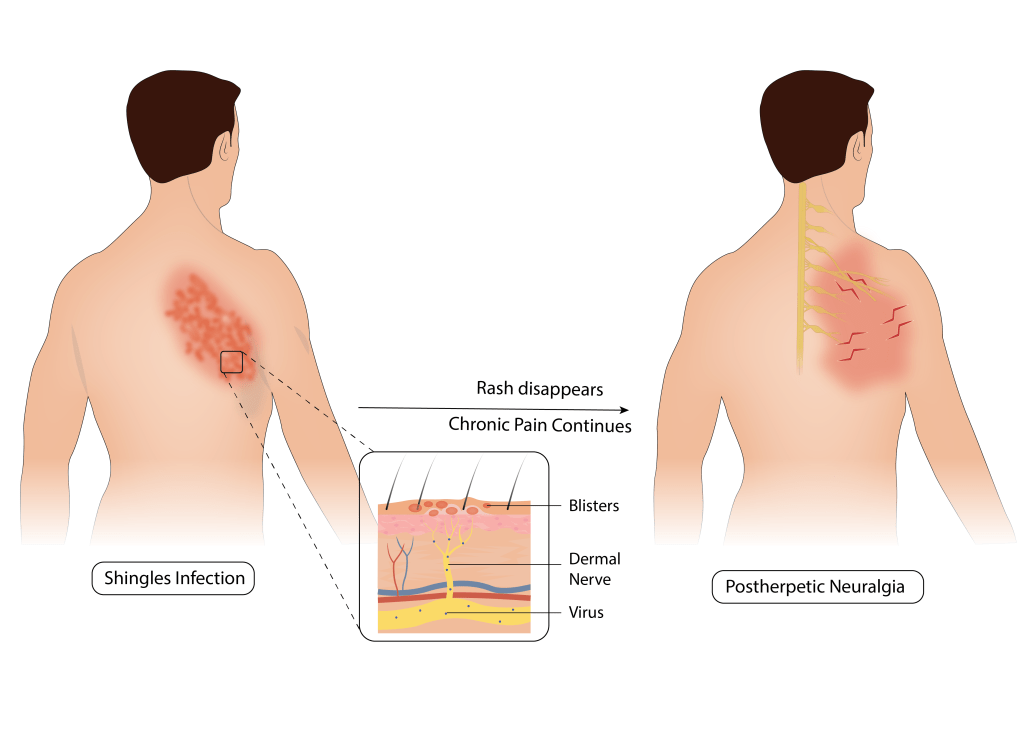 Post herpetic neuralgia 2