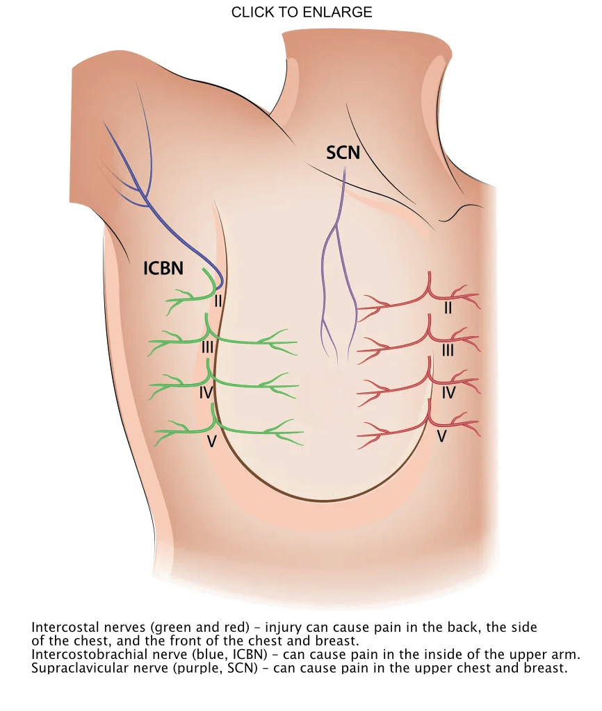 breast illustration of nerves impacted by mastectomy